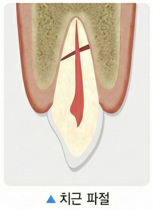 잇몸 아래 치아 뿌리가 부러진 치근 파절 그림