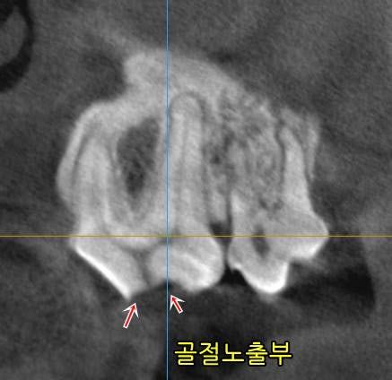 CT에서 확인한 골절 노출 부위(빨간 화살표)