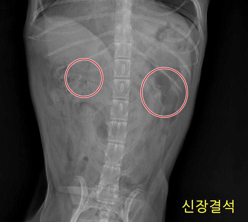 복부 방사선 사진에서 빨간 원으로 표시한 신장 결석