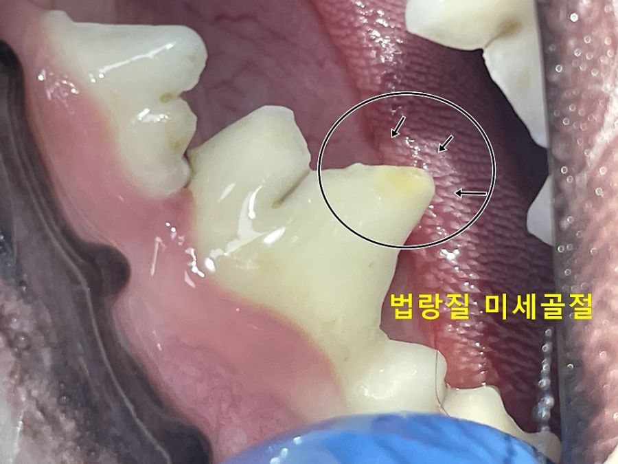 어금니 법랑질에 생긴 미세파절(동그라미 표시 부위)