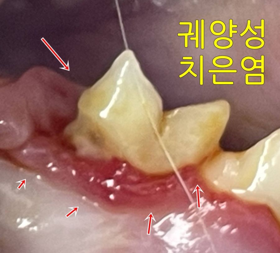 궤양성 치은염이 나타난 잇몸