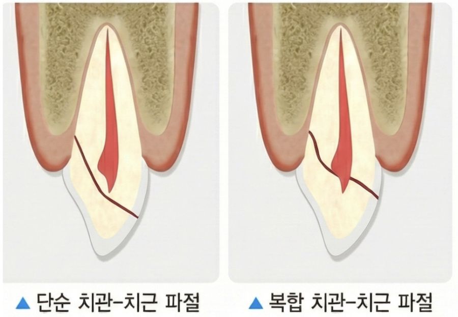 단순 치관-치근 파절과 복합 치관-치근 파절을 비교한 그림