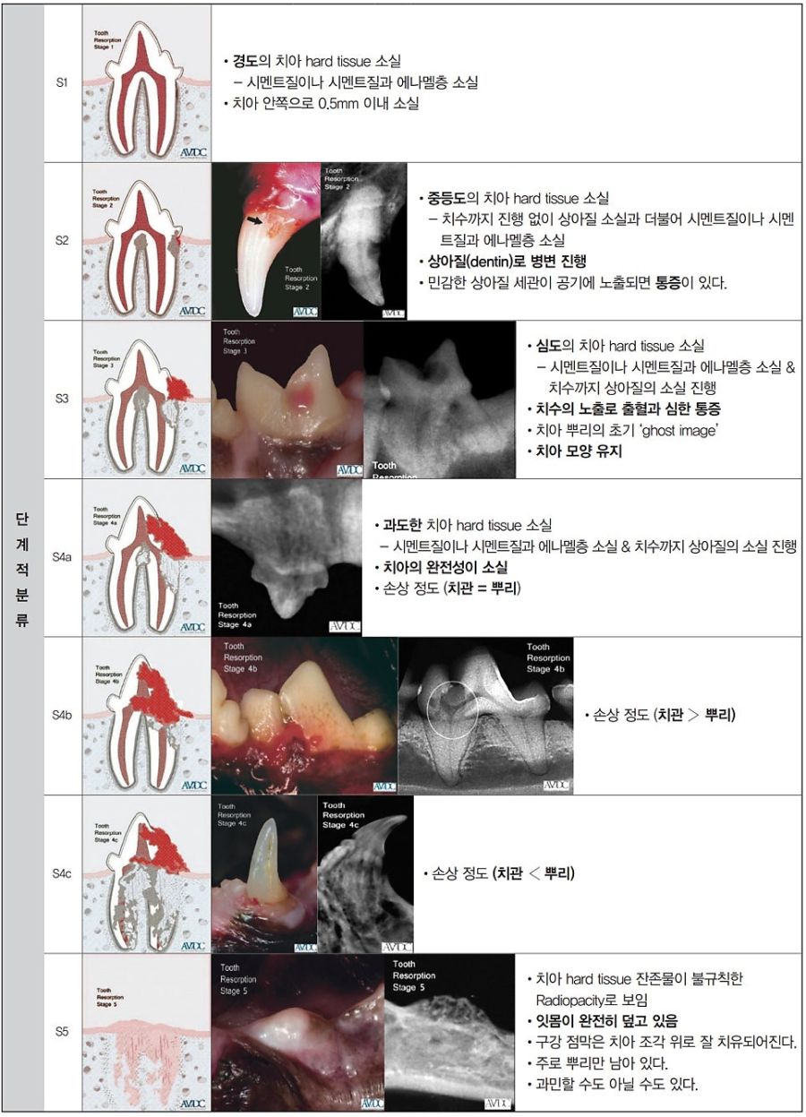 치아 흡수성 병변의 단계별 분류