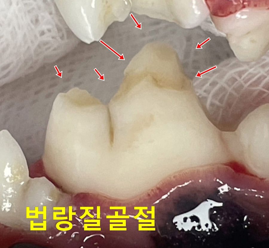 법랑질 일부가 떨어져 나간 치아(화살표 표시 부위)