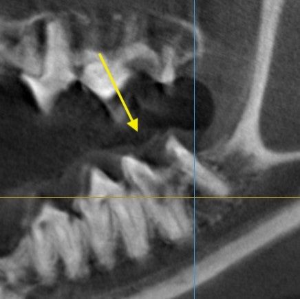 보키의 CBCT 단면 영상, 화살표가 가리키는 부위가 병변입니다