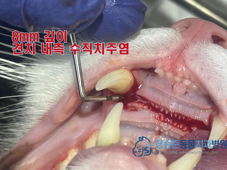 프로브로 측정한 8mm 깊이의 치주낭(송곳니 안쪽 수직 치주염)