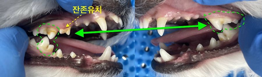 잔존유치가 남은 쪽과 유치가 빠진 쪽 어금니를 비교한 모습