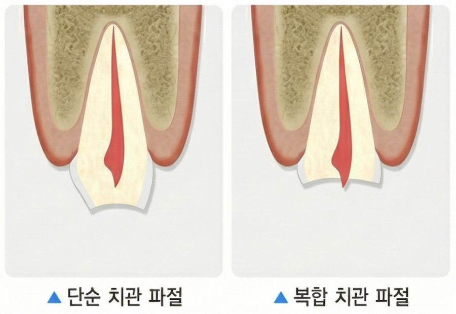 단순 치관 파절과 복합 치관 파절을 비교한 그림