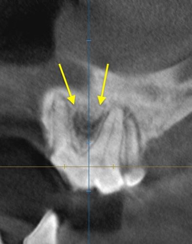 CBCT 단면 영상에서 화살표로 표시한 어금니 뿌리 주변