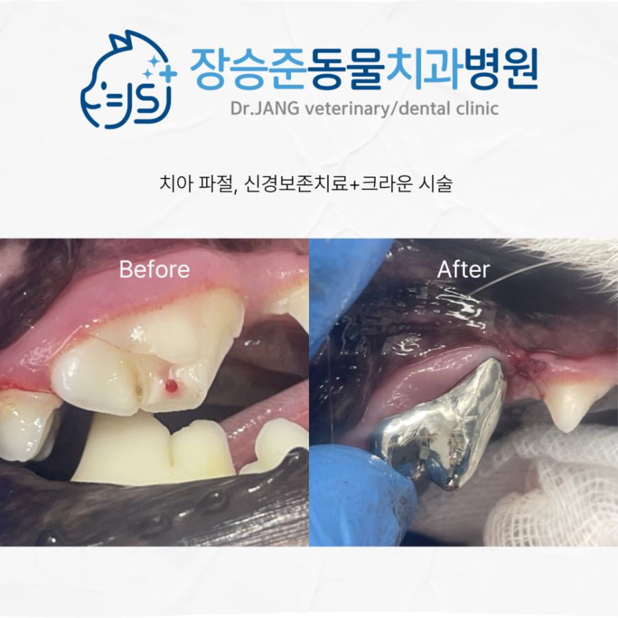 치아 파절 후 신경 보존 치료와 크라운 시술 전후 모습