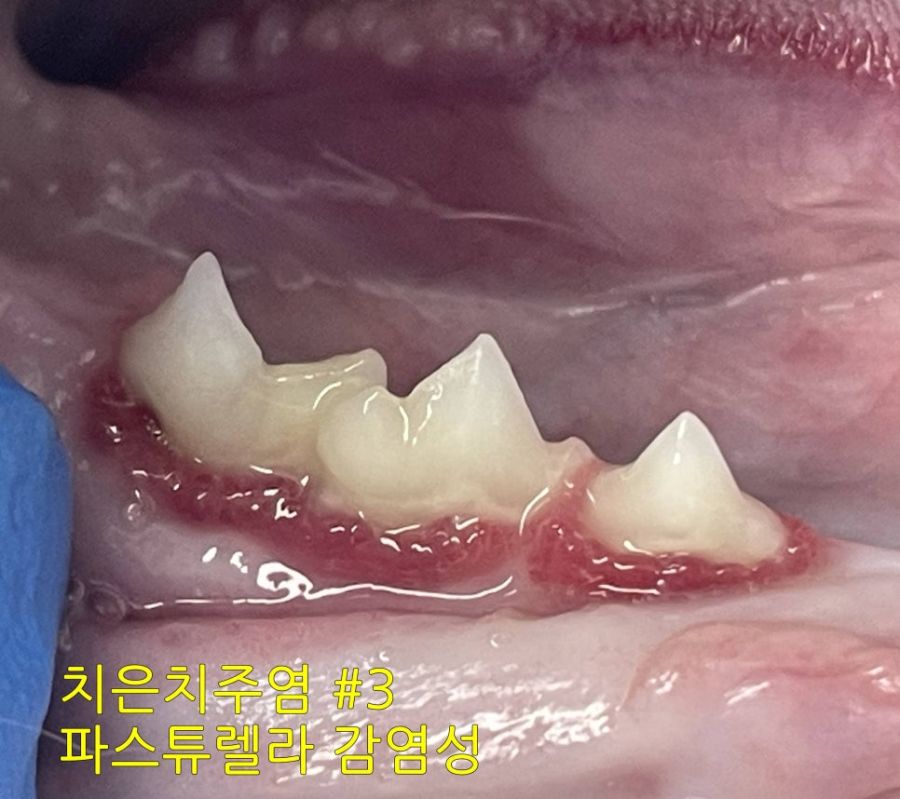 치아를 둘러싼 잇몸을 따라 붉은 염증이 올라온 모습