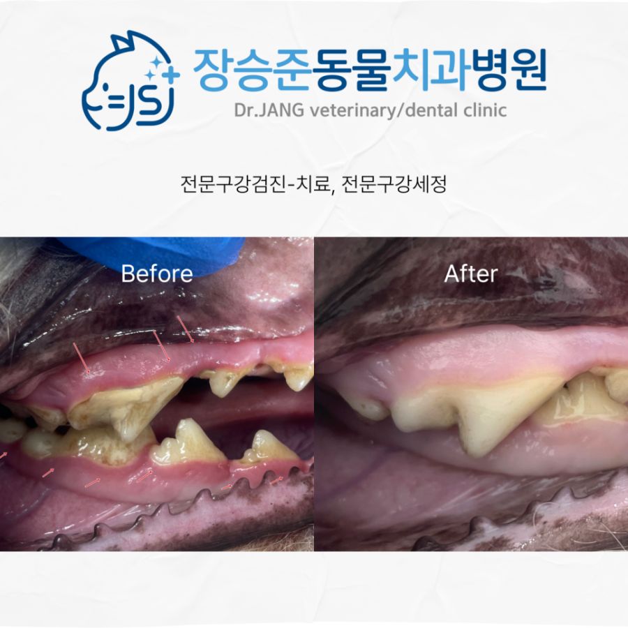 치석과 붉게 부은 잇몸(치료 전)과 치료 후 모습 비교