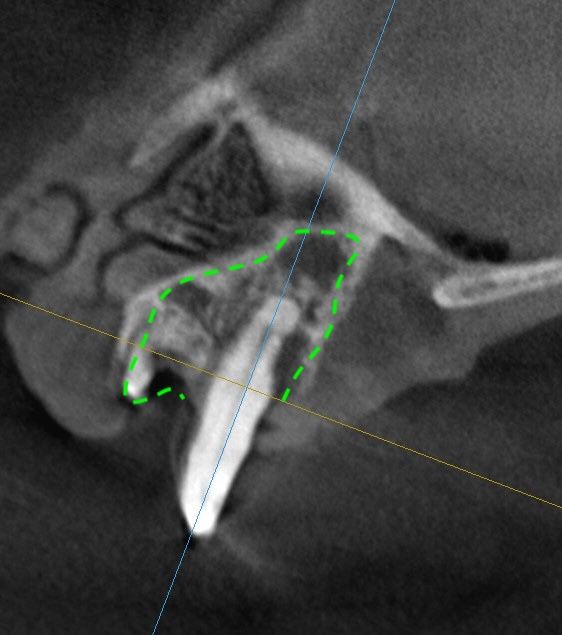 CBCT 영상. 뼈는 흰색으로 보여야 하지만 염증 부위가 검게 얼룩져 보입니다.