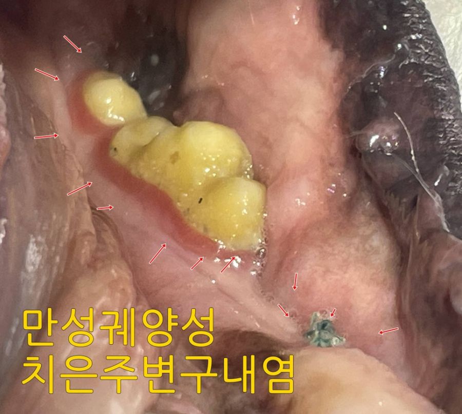 치아 주변 점막이 헐어 있는 만성 궤양성 치은주변 구내염 부위(화살표)