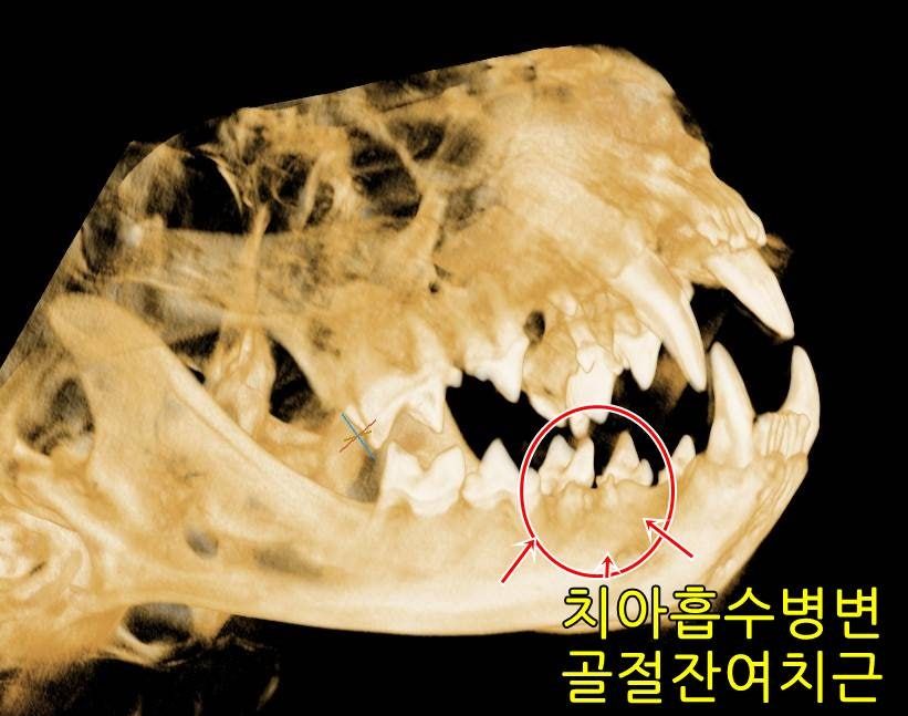 CBCT 영상에서 확인한 치아 흡수 병변과 부러진 채 남은 치아뿌리