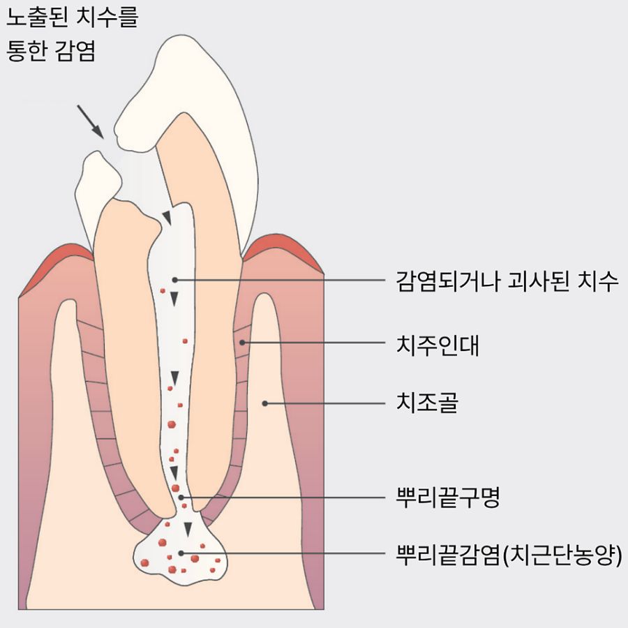 드러난 치수를 통해 뿌리 끝까지 감염이 진행되는 과정을 나타낸 그림